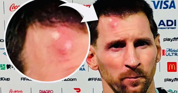 Messi sưng vêu trán sau trận thắng Cabo Verde: Vì sao nên nỗi? - hình ảnh - vipnews88.com